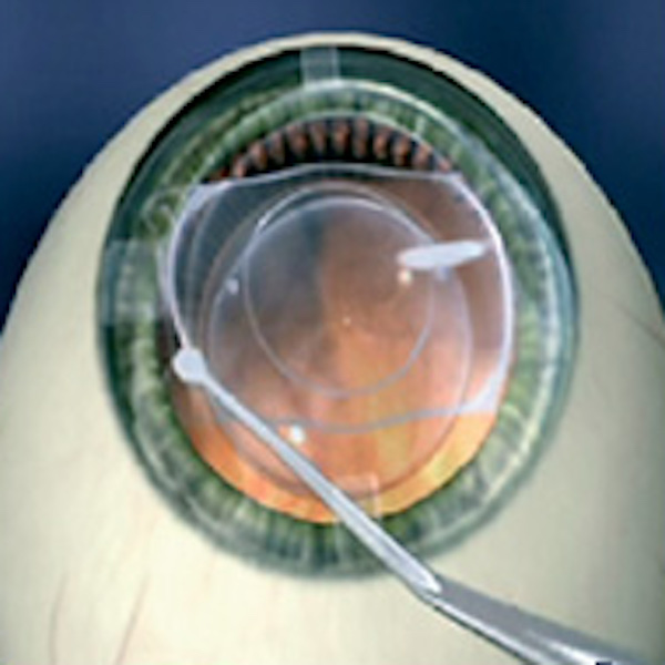 visian-phakic-lens-technology-s | Vision Surgery