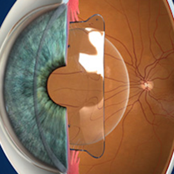 visian-phakic-lens-who-for-s-vision-surgery