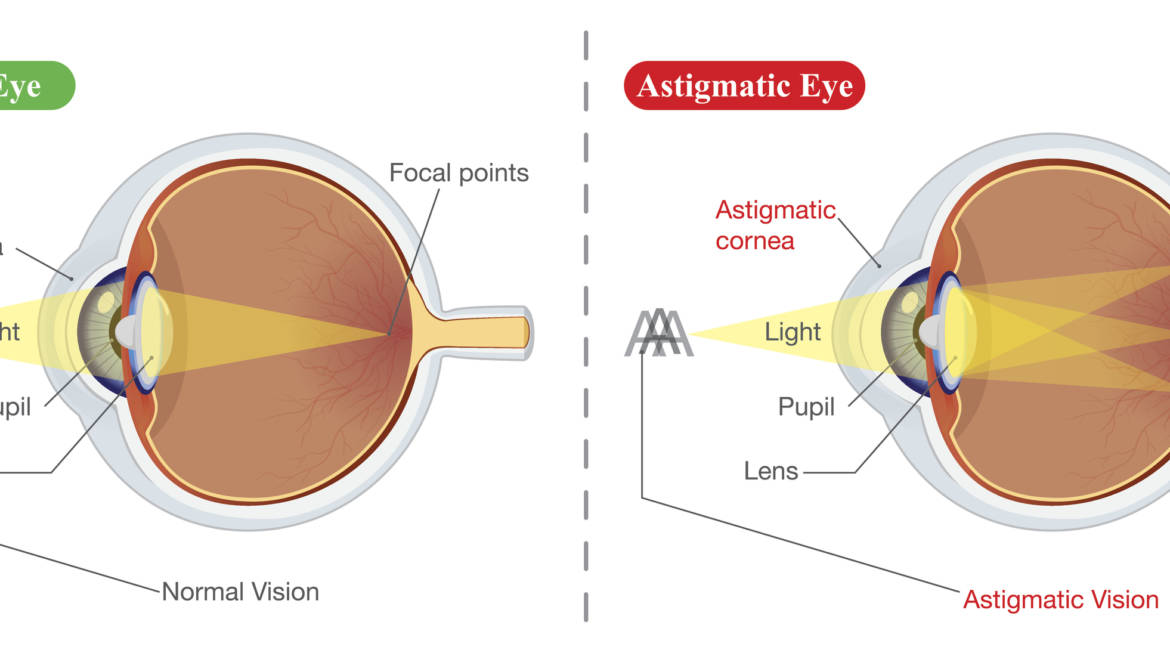 I have astigmatism, so does that mean I’m not suitable for laser eye surgery?