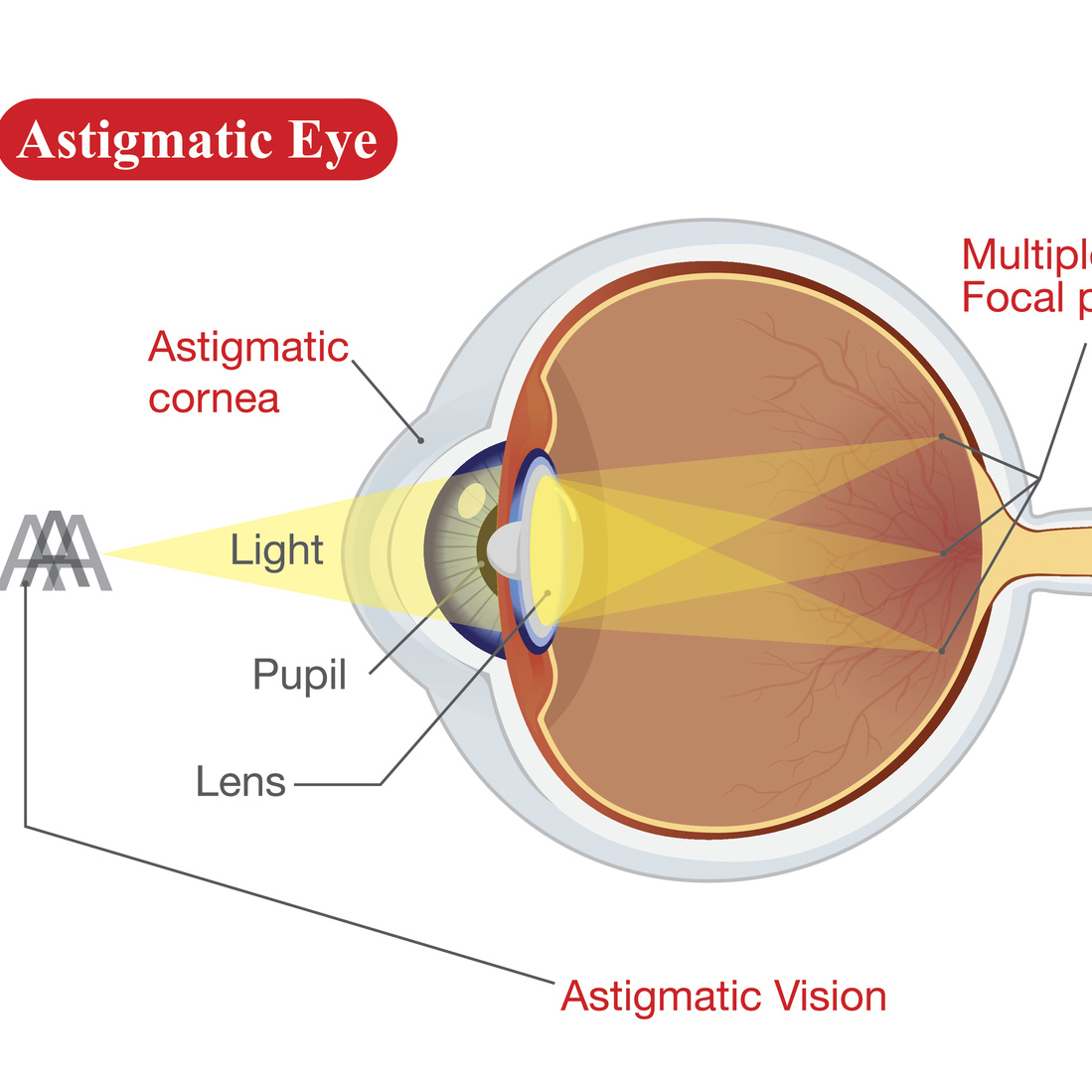 Vision of Normal eye and Astigmatic | Vision Surgery