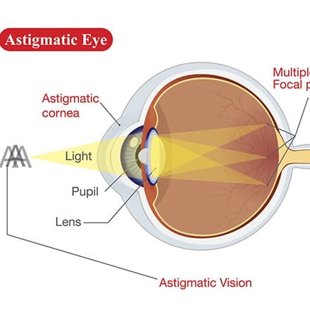 I have astigmatism, so am I suitable for laser eye surgery?